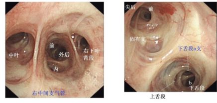 leyu.体育(中国)官方网站7步教你掌握支气管肺泡灌洗术！建议收藏